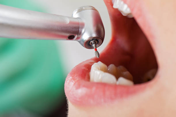 Best Emergency Dental Extractions in Leesburg, GA